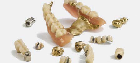 Zahngold – Brücken – Kronen