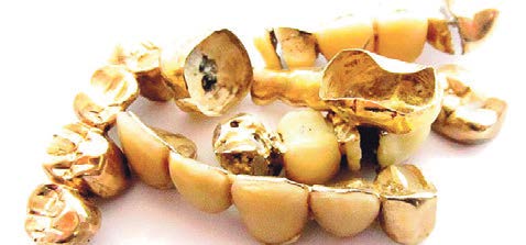 Zahngold – Inlays mit Zähnen